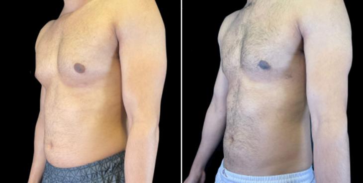 Before & After Male Breast Reduction Atlanta