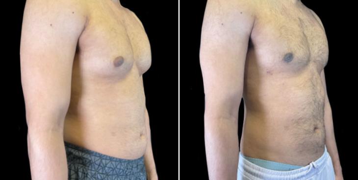 Before & After Male Breast Reduction Atlanta GA