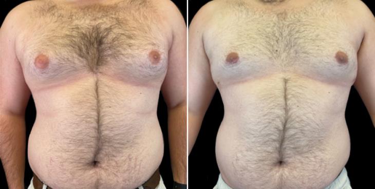 Male Breast Reduction Surgery Results