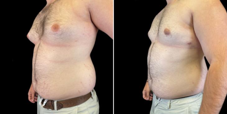 Results Of Male Breast Reduction Surgery
