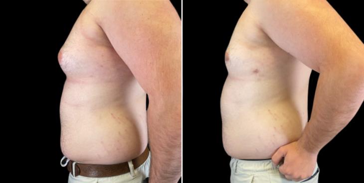 Male Breast Reduction Surgery Results Atlanta