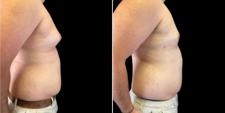 Before & After Gynecomastia