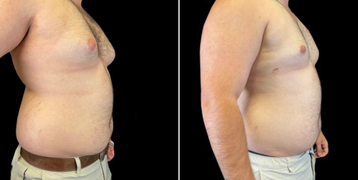 Results Of Male Breast Reduction Surgery Atlanta