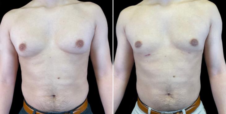 Gynecomastia Before & After