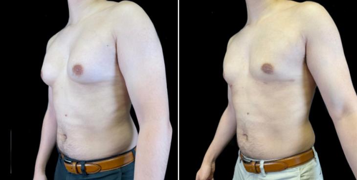 Gynecomastia Before & After Atlanta