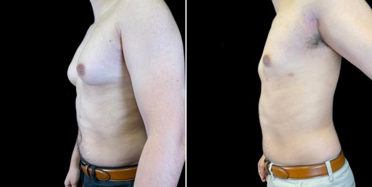 Atlanta Gynecomastia Before & After