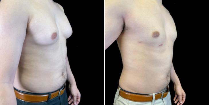 Before And After Gynecomastia Atlanta