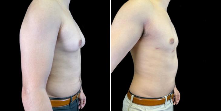 Atlanta Gynecomastia Before And After