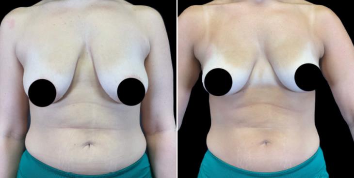 Breast Lift Results Marietta GA