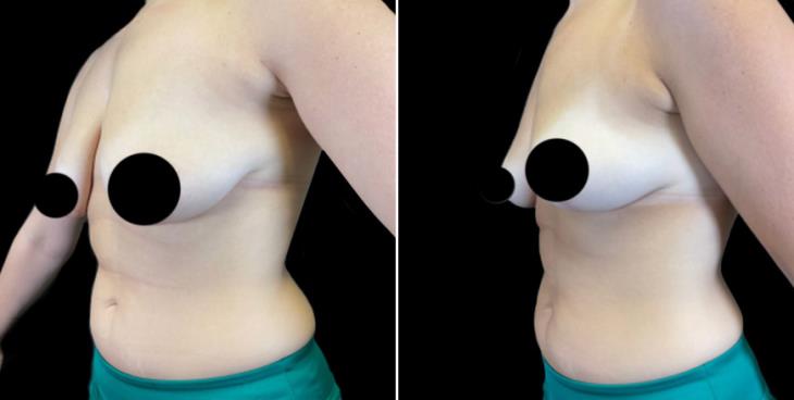 Marietta GA Breast Lift Results