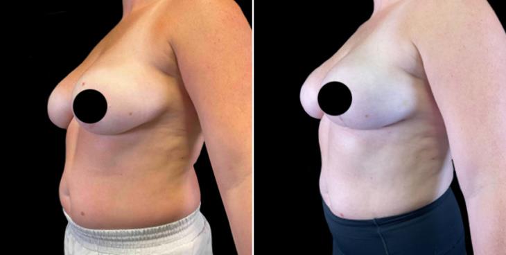 Before & After Breast Lift Marietta GA