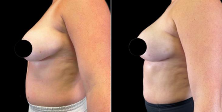 Marietta GA Before & After Breast Lift