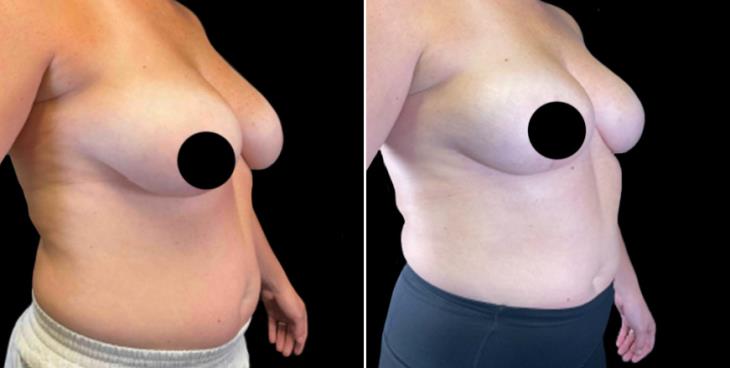 Before And After Breast Lift Marietta Georgia