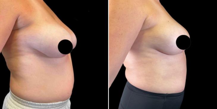Marietta Georgia Before And After Breast Lift