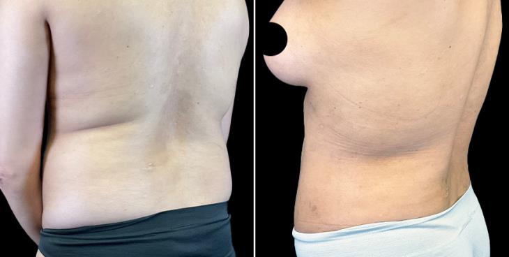 Cumming Tummy Tuck Results ¾ View