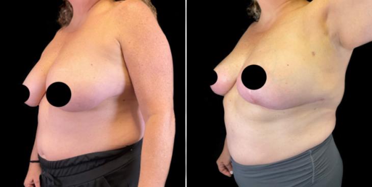 Atlanta GA Reduction Mammoplasty Surgery