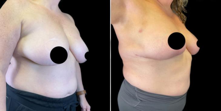 Reduction Mammoplasty Results Atlanta GA