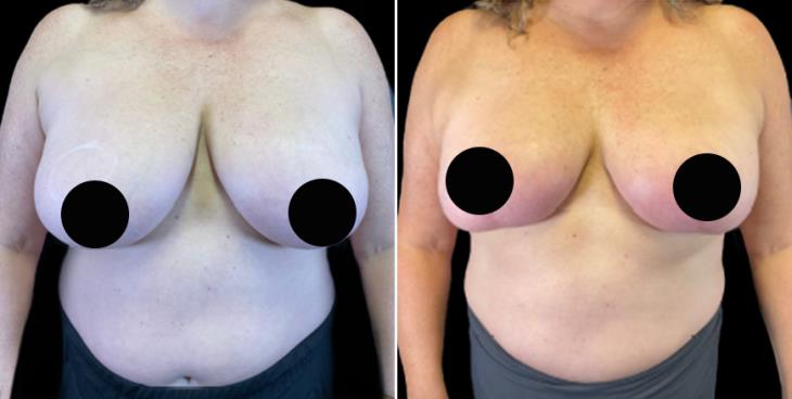 Reduction Mammoplasty Atlanta GA