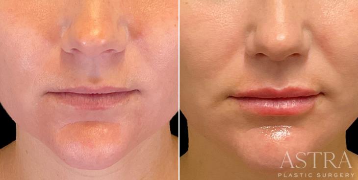 Lip & Cheek Cosmetic Filler