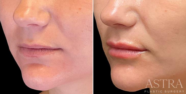 Lip And Cheek Cosmetic Filler