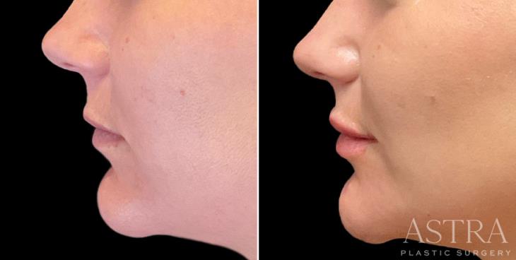 Lip & Cheek Cosmetic Filler Results