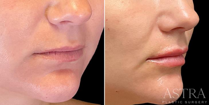 Lip And Cheek Cosmetic Filler Results
