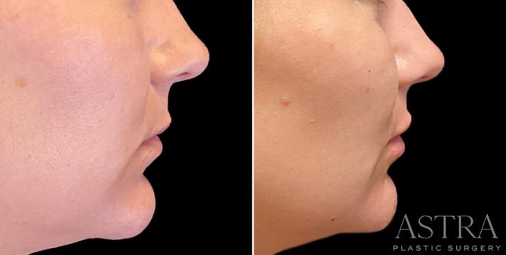 Results Of Lip & Cheek Cosmetic Filler
