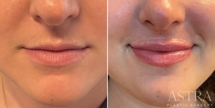 Lip Enhancement Results Marietta