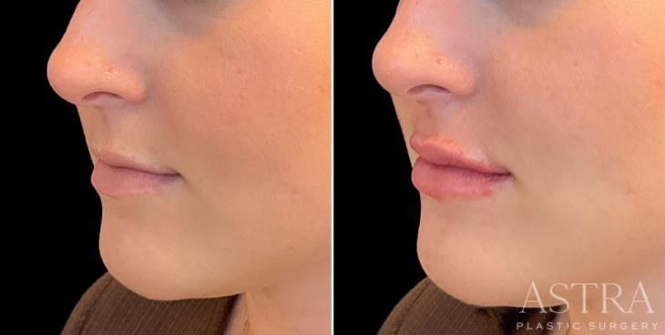 Marietta Lip Enhancement Results