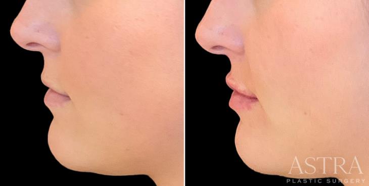 Marietta Lip Enhancement Results Side View