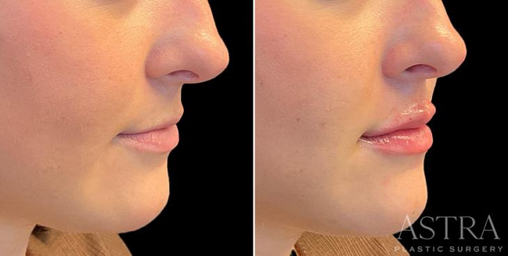 Marietta Lip Enhancement Results ¾ View