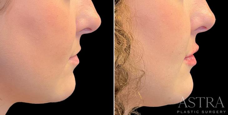 Side View Marietta Lip Enhancement Results
