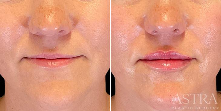 Lip Filler Results Marietta