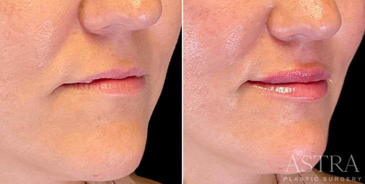 Results Of Lip Filler Marietta