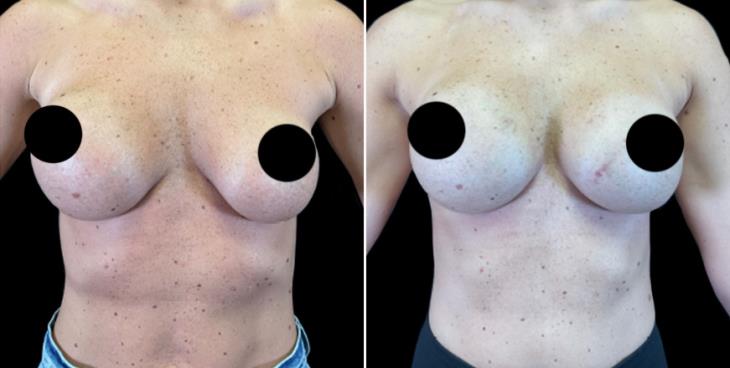 Breast Implant Exchange Atlanta
