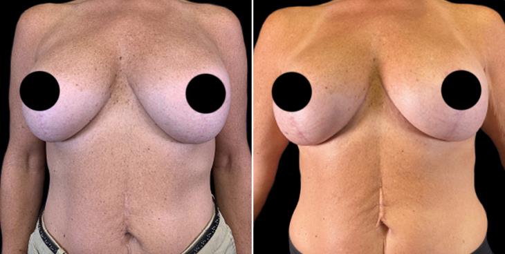 Before & After Breast Implant Exchange