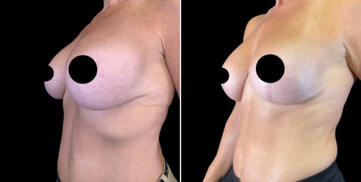 Breast Implant Exchange Side View