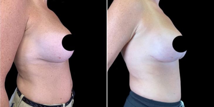 Breast Implant Exchange Before And After