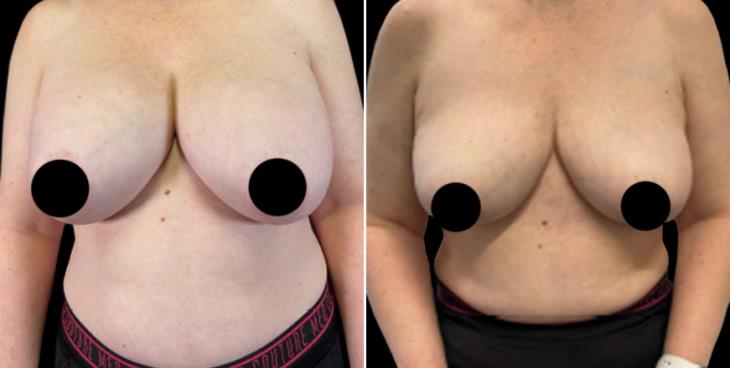 Breast Implant Removal & Lift