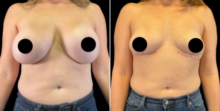 Breast Implant Removal & Lift Atlanta
