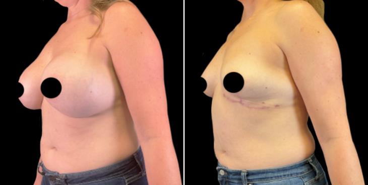 Atlanta Breast Implant Removal & Lift