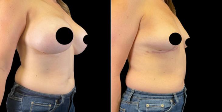 Breast Implant Removal & Lift Results