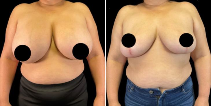 Results Of Breast Implant Removal & Lift