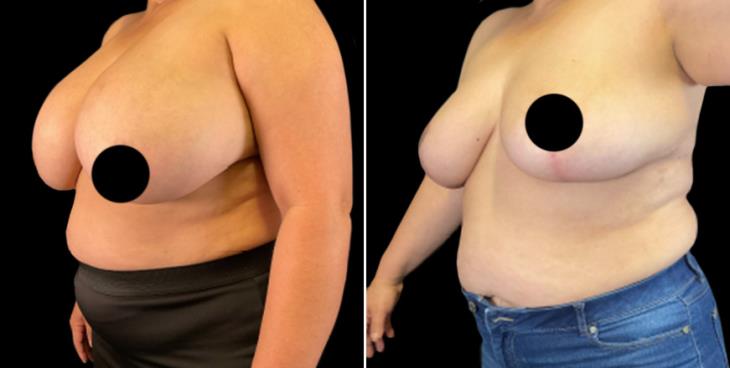 Before & After Breast Implant Removal & Lift