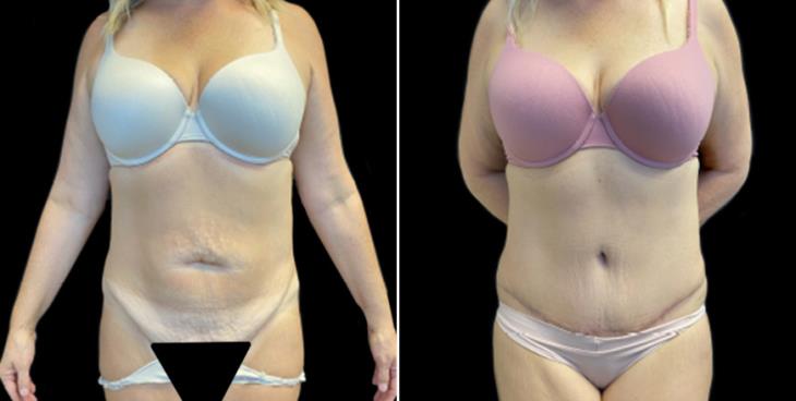 Abdominoplasty Surgery