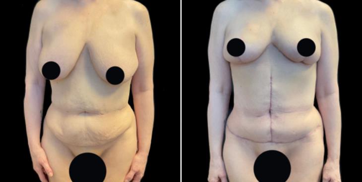 Abdominoplasty Surgery Georgia