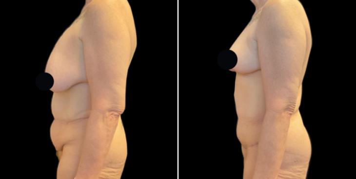 Georgia Abdominoplasty Surgery