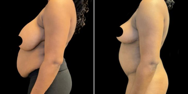 Atlanta Abdominoplasty Surgery Results