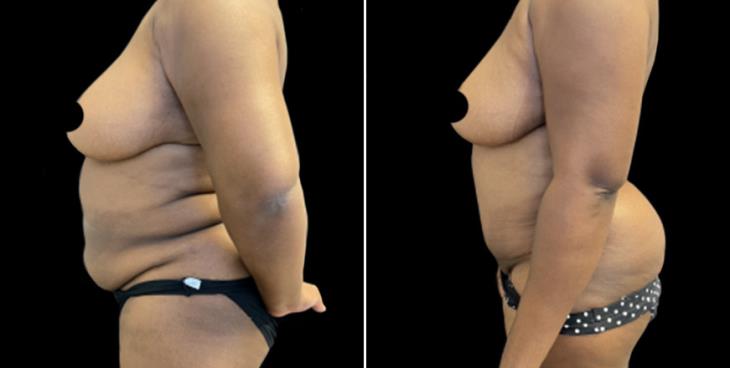 Abdominoplasty Surgery Results Marietta