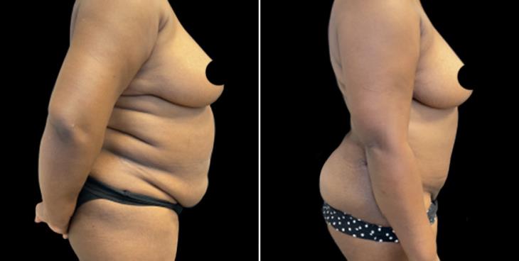 Abdominoplasty Surgery Results Marietta GA